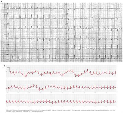 Apple Watch-guided diagnosis of AVNRT in a pregnant woman—A case report and literature review